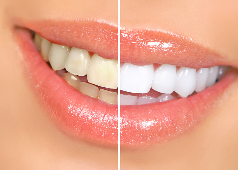 Simple Ways to Improve Teeth