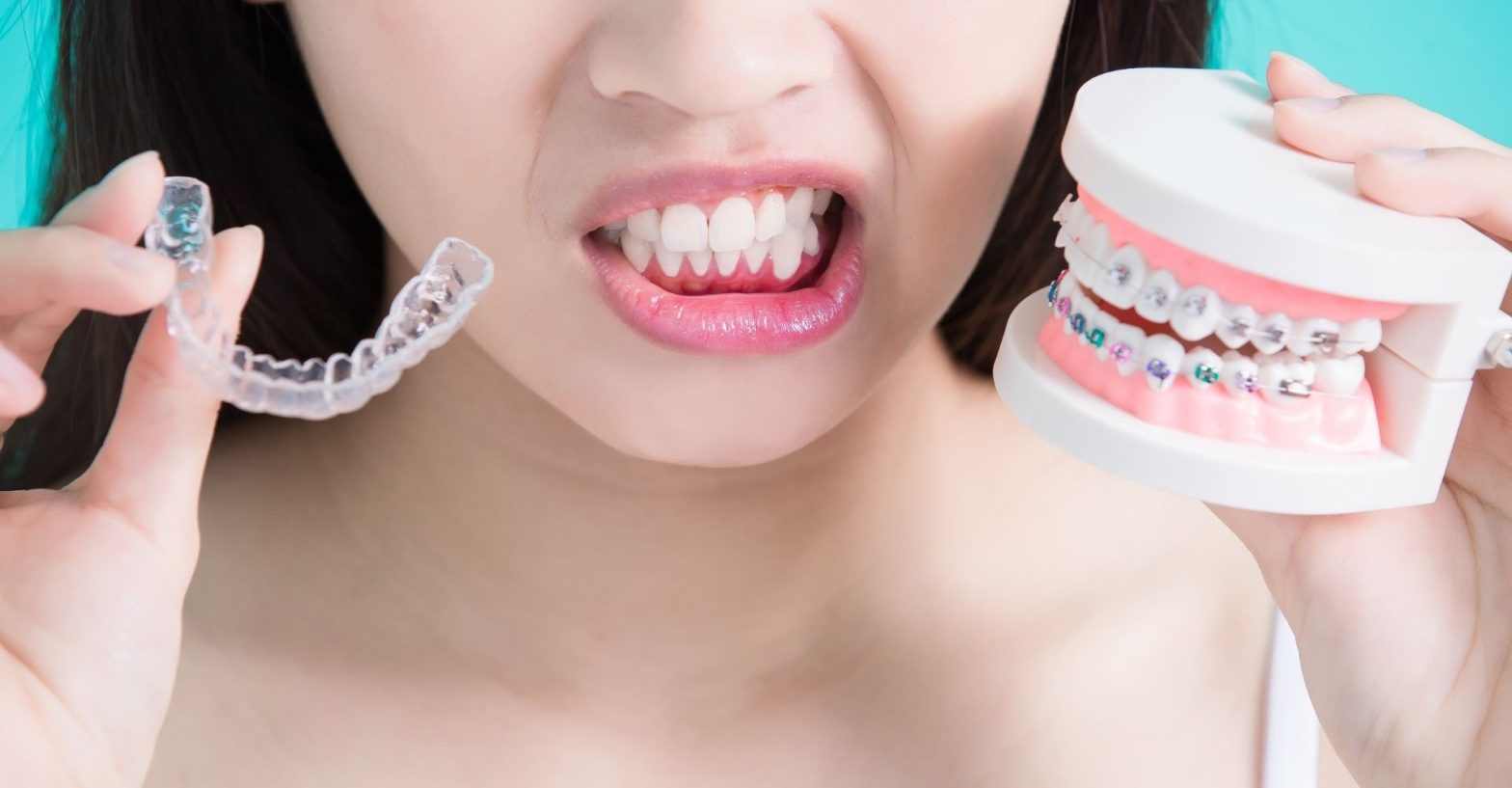 Clear Aligners: A Modern Alternative to Traditional Braces