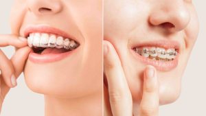 Braces vs Clear Aligners: Which Orthodontic Treatment Works Best?