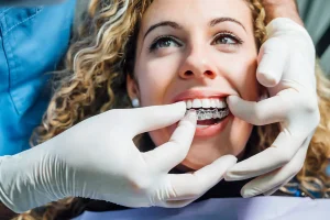Clear Aligners: A Modern Alternative to Traditional Braces