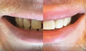 Dental Veneers: The Secret to a Perfect Smile?