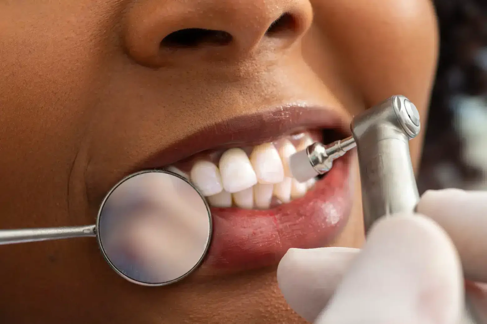 From Plaque to Polish: The Journey of a Dental Cleaning Visit