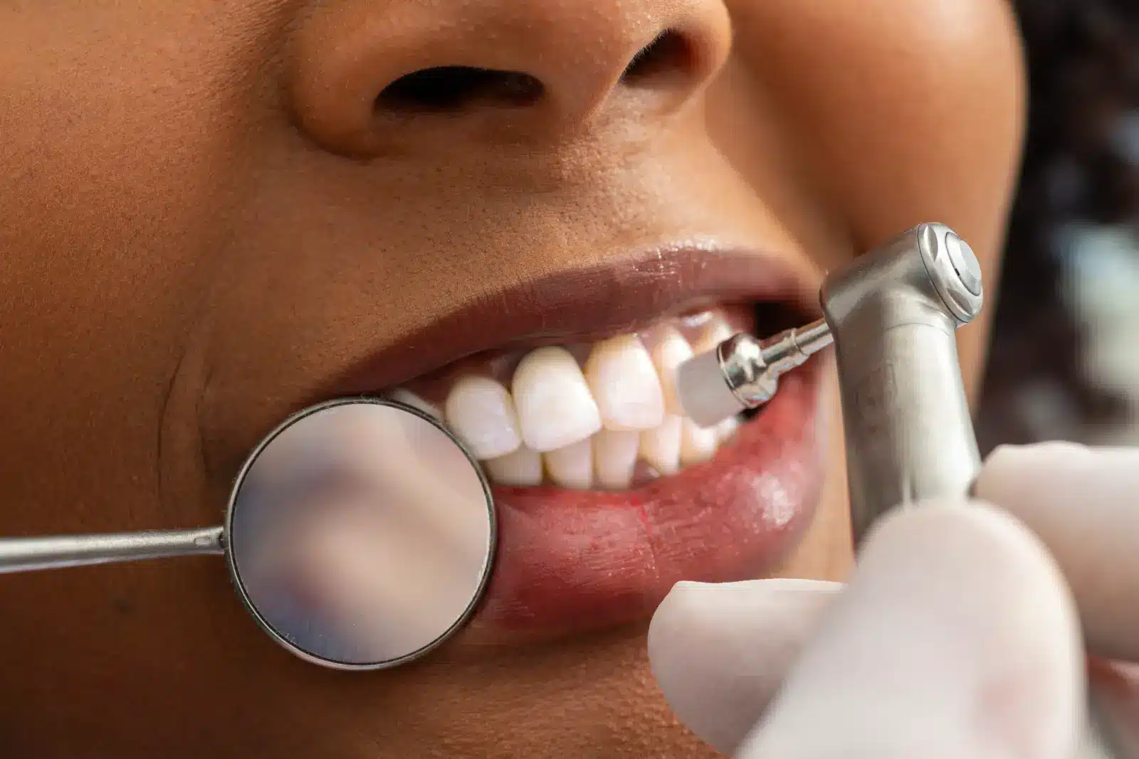 From Plaque to Polish: The Journey of a Dental Cleaning Visit