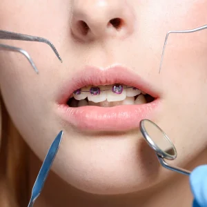 How Long Does Orthodontic Treatment Really Take?