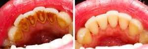 How Often Should You Get Your Teeth Cleaned?