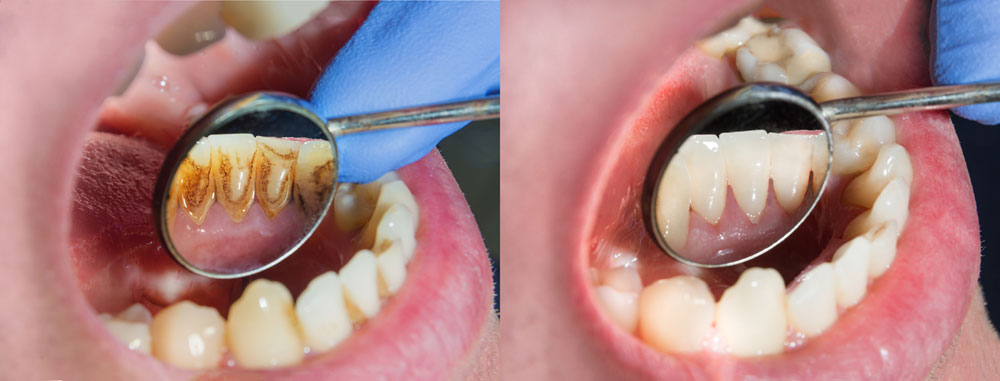 How Often Should You Get Your Teeth Cleaned?