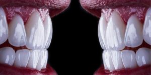 Porcelain vs Composite Veneers: Pros and Cons Porcelain vs Composite Veneers: Pros and Cons