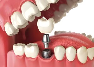 Common Questions Patients Ask About Dental Implants