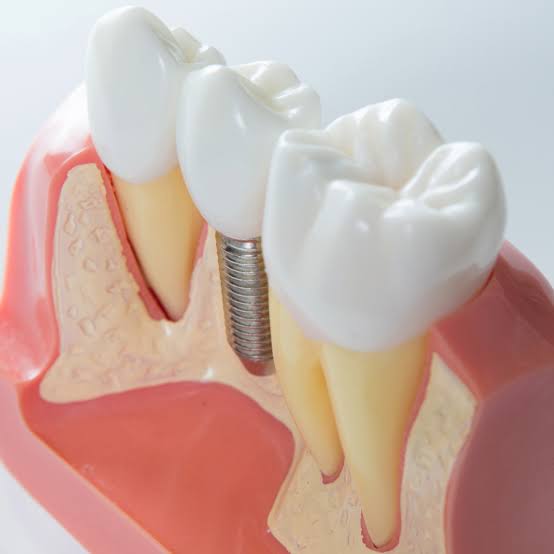 Common Questions Patients Ask About Dental Implants