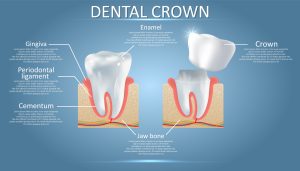 Dental Crowns Explained: When You Need a Tooth Cap and Why Dental Crowns Explained: When You Need a Tooth Cap and Why