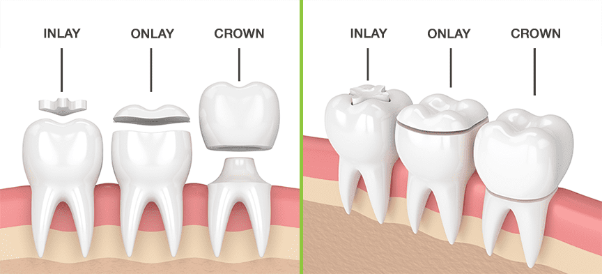 Dental Crowns Explained: When You Need a Tooth Cap and Why
