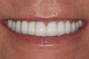 Do Dental Implants Look Natural?