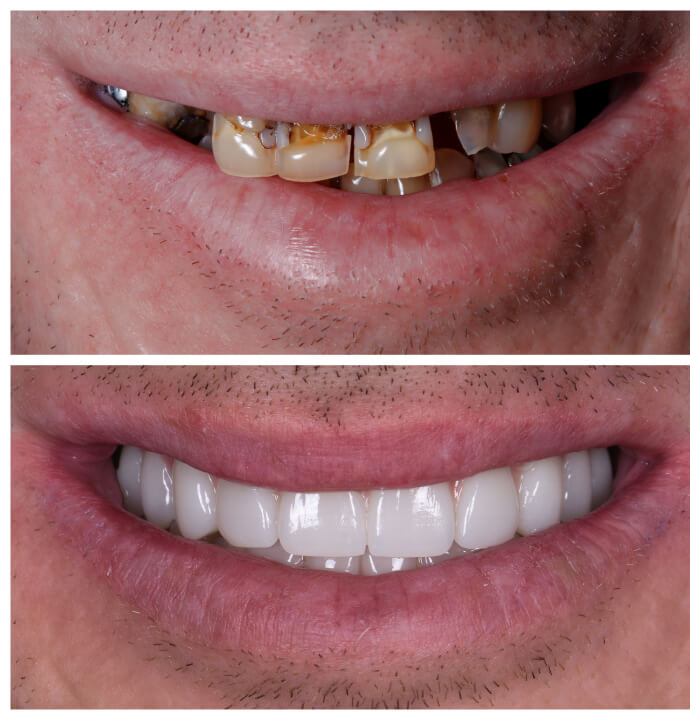 Do Dental Implants Look Natural?