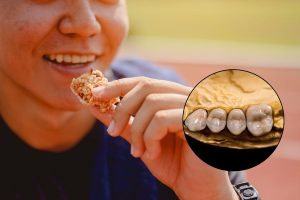 Foods to Avoid After Getting a Dental Crown