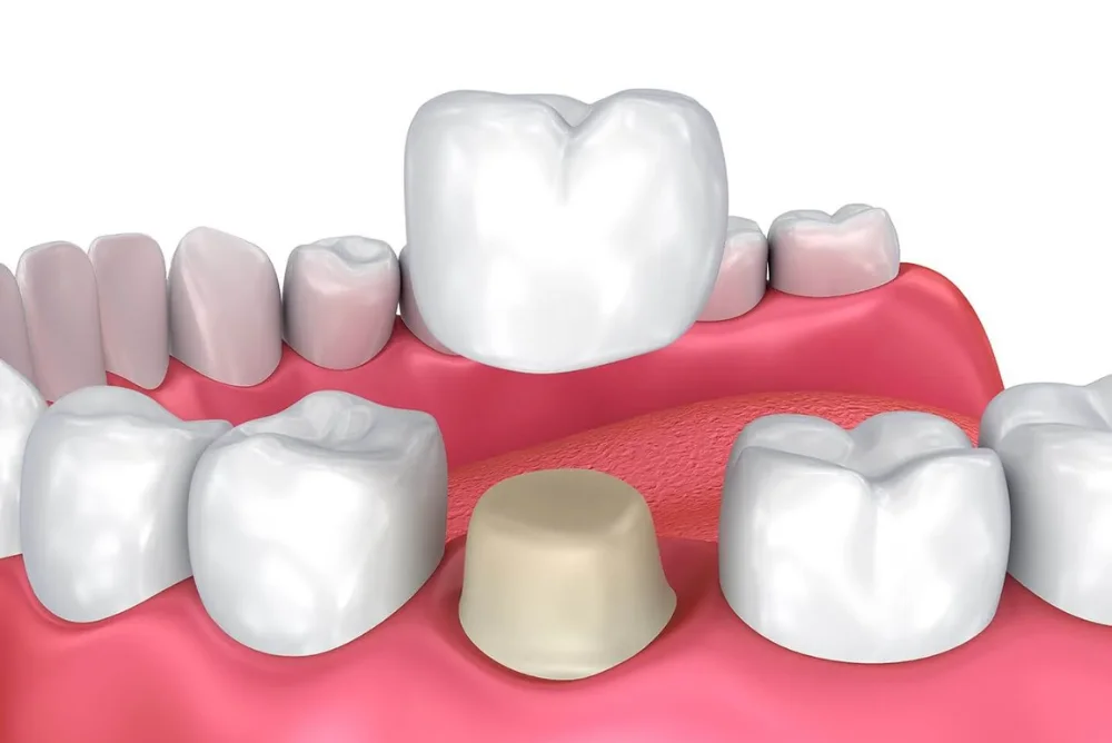 How Dental Crowns Restore Damaged Teeth and Improve Oral Health