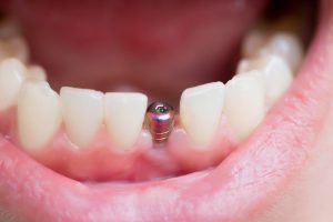 How Long Do Dental Implants Last?