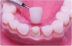 The Science Behind Tooth Caps: How They Protect Your Teeth The Science Behind Tooth Caps: How They Protect Your Teeth