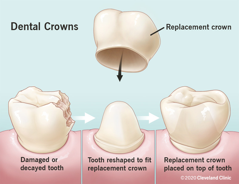 The Science Behind Tooth Caps: How They Protect Your Teeth