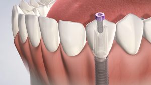 The Truth About Dental Implant Pain and Recovery