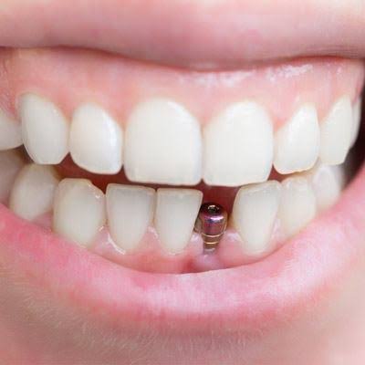 The Truth About Dental Implant Pain and Recovery