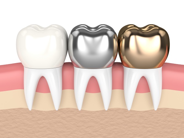 What Are Tooth Caps? A Complete Guide to Dental Crowns