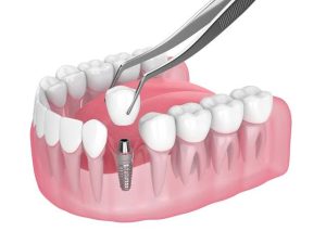 What to Expect Before, During, and After Dental Implant Surgery