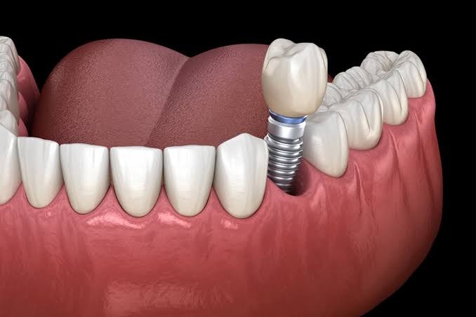 What to Expect Before, During, and After Dental Implant Surgery