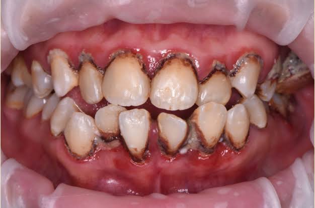 Diabetes and Gum Disease: How They Affect Each Other