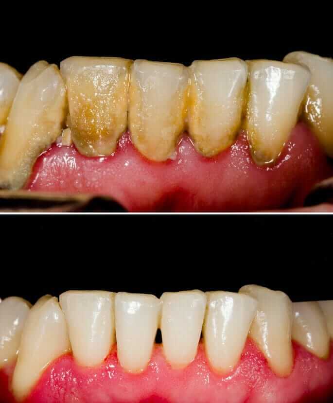What to Expect During Gum Disease Treatment at the Dentist