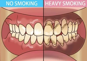 Smoking and Gum Disease: The Dangerous Connection Explained Smoking and Gum Disease: The Dangerous Connection Explained