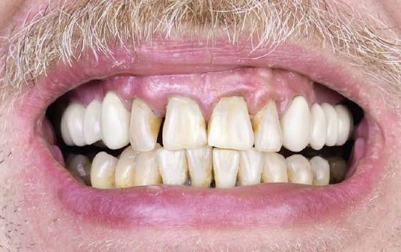Smoking and Gum Disease: The Dangerous Connection Explained