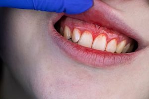 Stress and Oral Health: Can Stress Worsen Gum Disease? Stress and Oral Health: Can Stress Worsen Gum Disease?