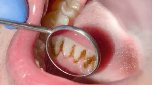 Who Is at Risk of Gum Disease? Key Factors You Should Know Who Is at Risk of Gum Disease? Key Factors You Should Know