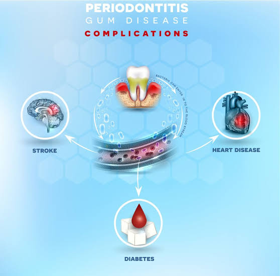 Who Is at Risk of Gum Disease? Key Factors You Should Know