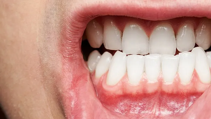 Why Gum Disease Is More Common Than You Think