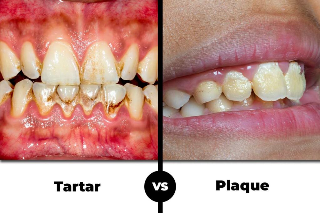 7 Causes of Plaque Buildup on Your Teeth