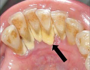 7 Causes of Plaque Buildup on Your Teeth 7 Causes of Plaque Buildup on Your Teeth