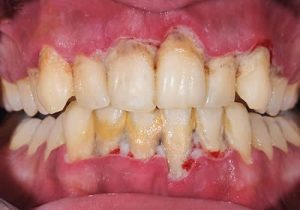 Can Plaque Cause Bad Breath? Can Plaque Cause Bad Breath?