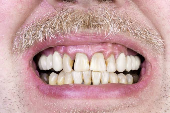 Can Plaque Cause Bad Breath?