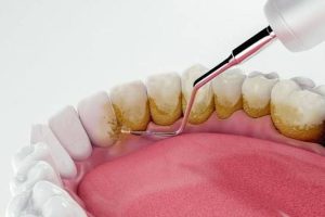 Does Mouthwash Remove Plaque? Does Mouthwash Remove Plaque?