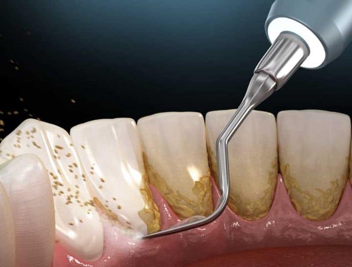 Does Mouthwash Remove Plaque?