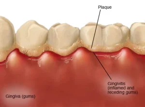 How Does Plaque Form on Teeth?