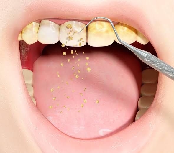 How Does Plaque Form on Teeth?