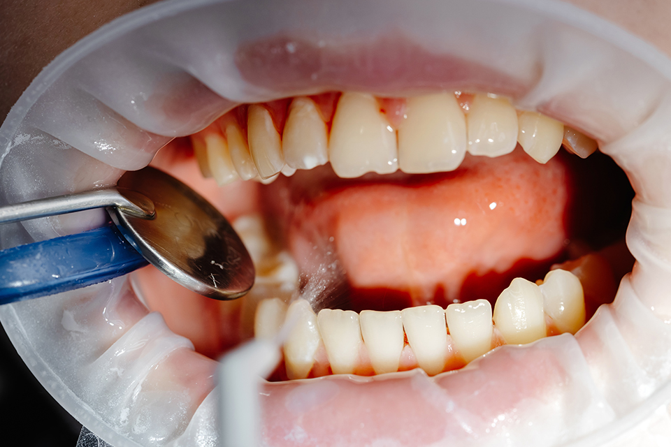 How Professional Teeth Cleaning Removes Plaque and Tartar
