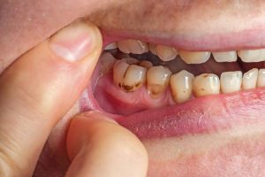 How to Prevent Cavities Before They Start