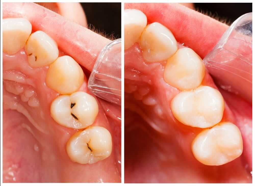 How to Prevent Cavities Before They Start