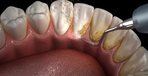 How to Prevent Plaque Buildup Naturally How to Prevent Plaque Buildup Naturally