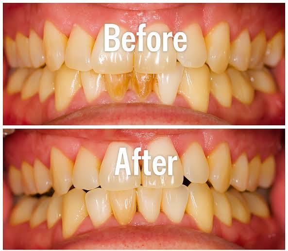 How to Tell If Plaque Is Turning Into Tartar