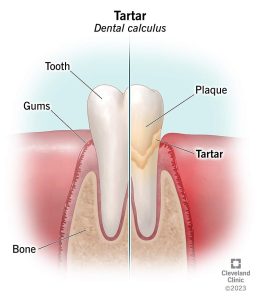 How to Tell If Plaque Is Turning Into Tartar How to Tell If Plaque Is Turning Into Tartar