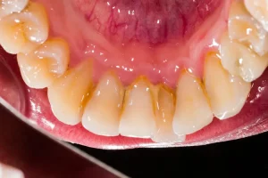 Plaque on Your Teeth: Causes, Risks, and Prevention Plaque on Your Teeth: Causes, Risks, and Prevention